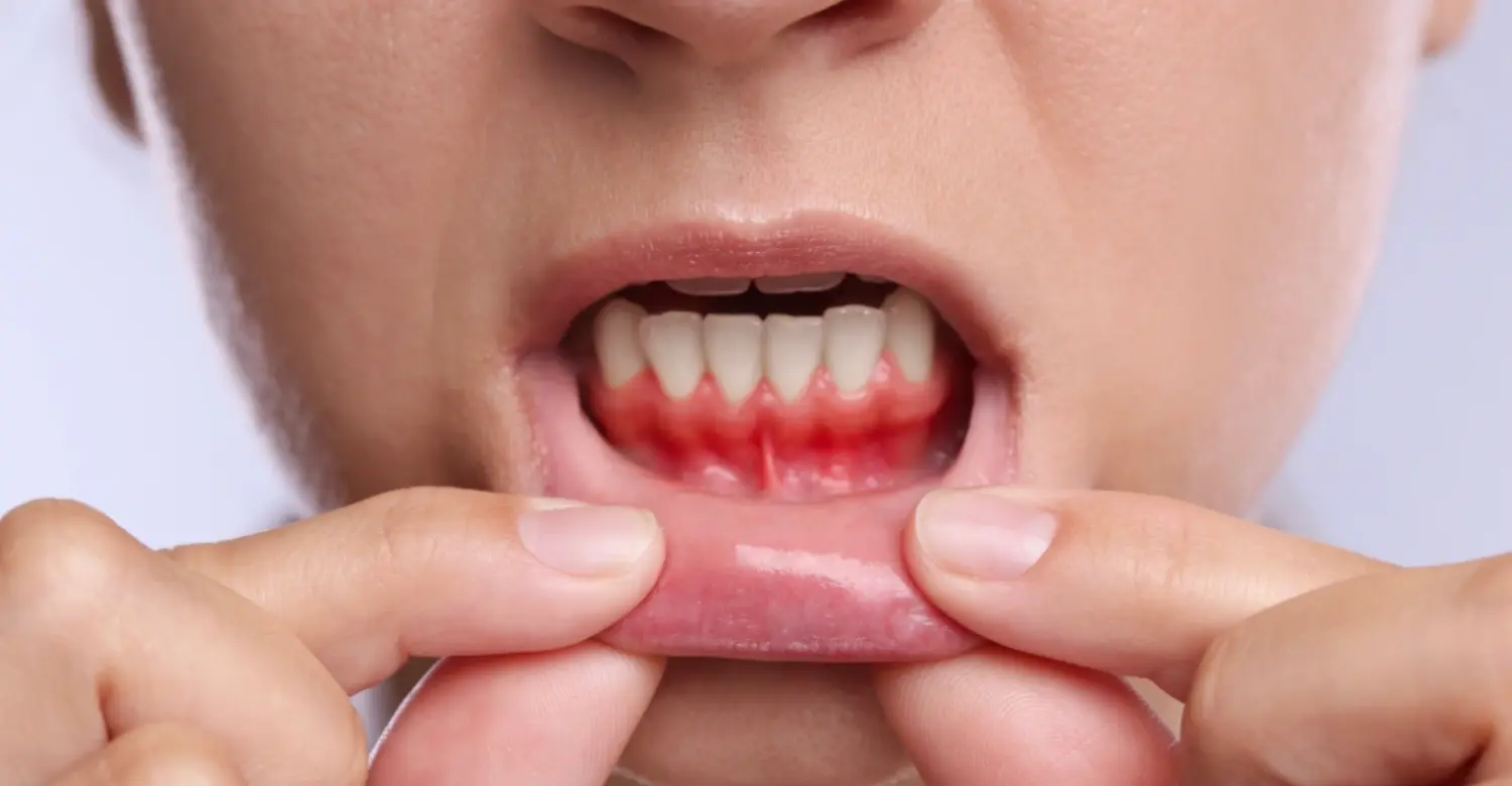 Receding Gums Stages 2